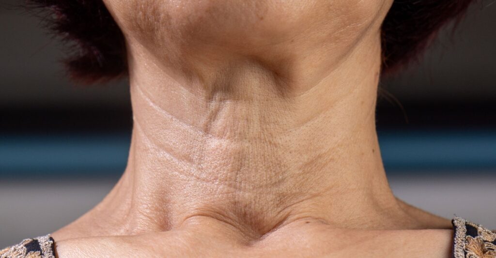 aging neck
