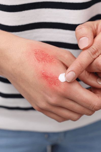 applying-ointment-on-burn-scar