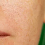 pigmentation